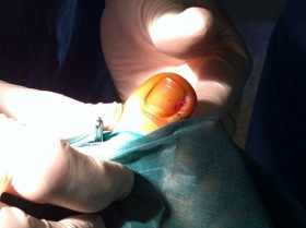 Cirurgia ungla clavada- Onicocriptosi - Exòstosi subunguial - Podòleg  Dr. Joan Figueras